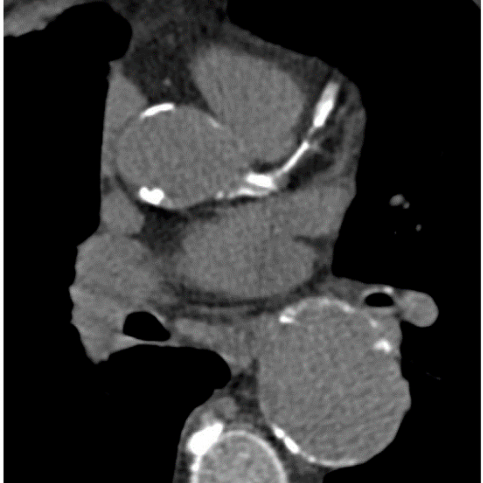 Coronary calcification image